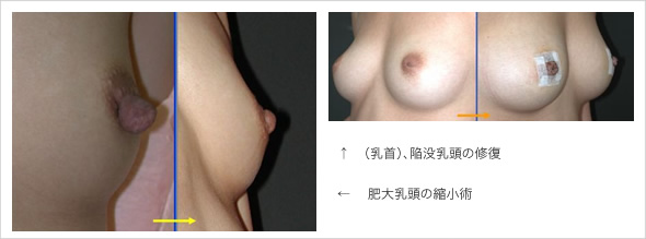 乳首写真 高須クリニック