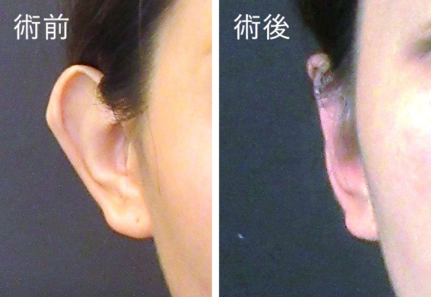 立ち耳修正術の症例画像