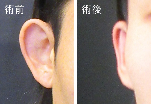 立ち耳修正術の症例画像